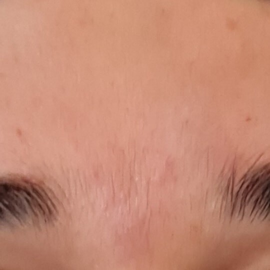 forhead after 3 compressed