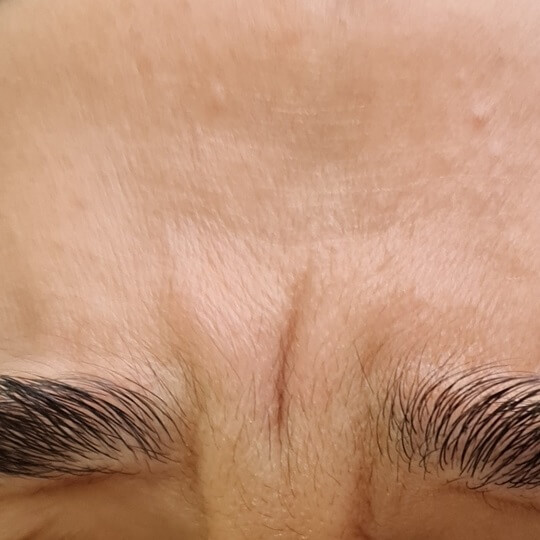 forhead before 3 compressed