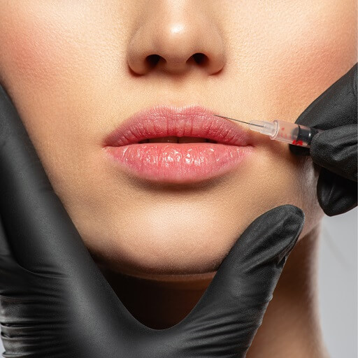 lips filler 67KB