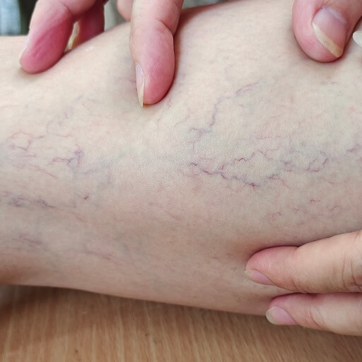 varicose veins 47KB