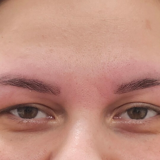 glabella afterrrr compressed