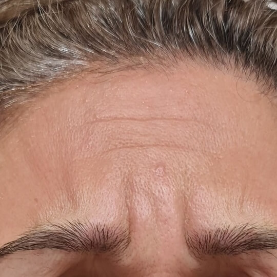 glabella before compressed