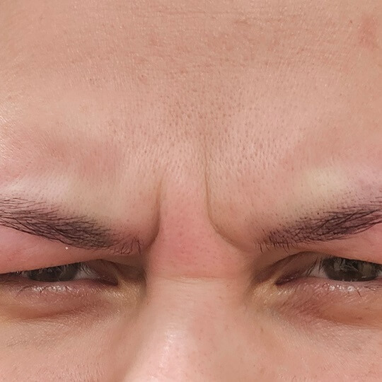 glabella132124236243 before compressed