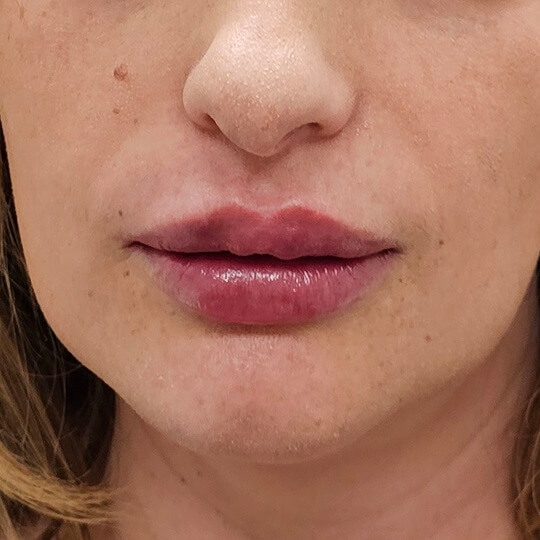 lips 9 after 31 compressed